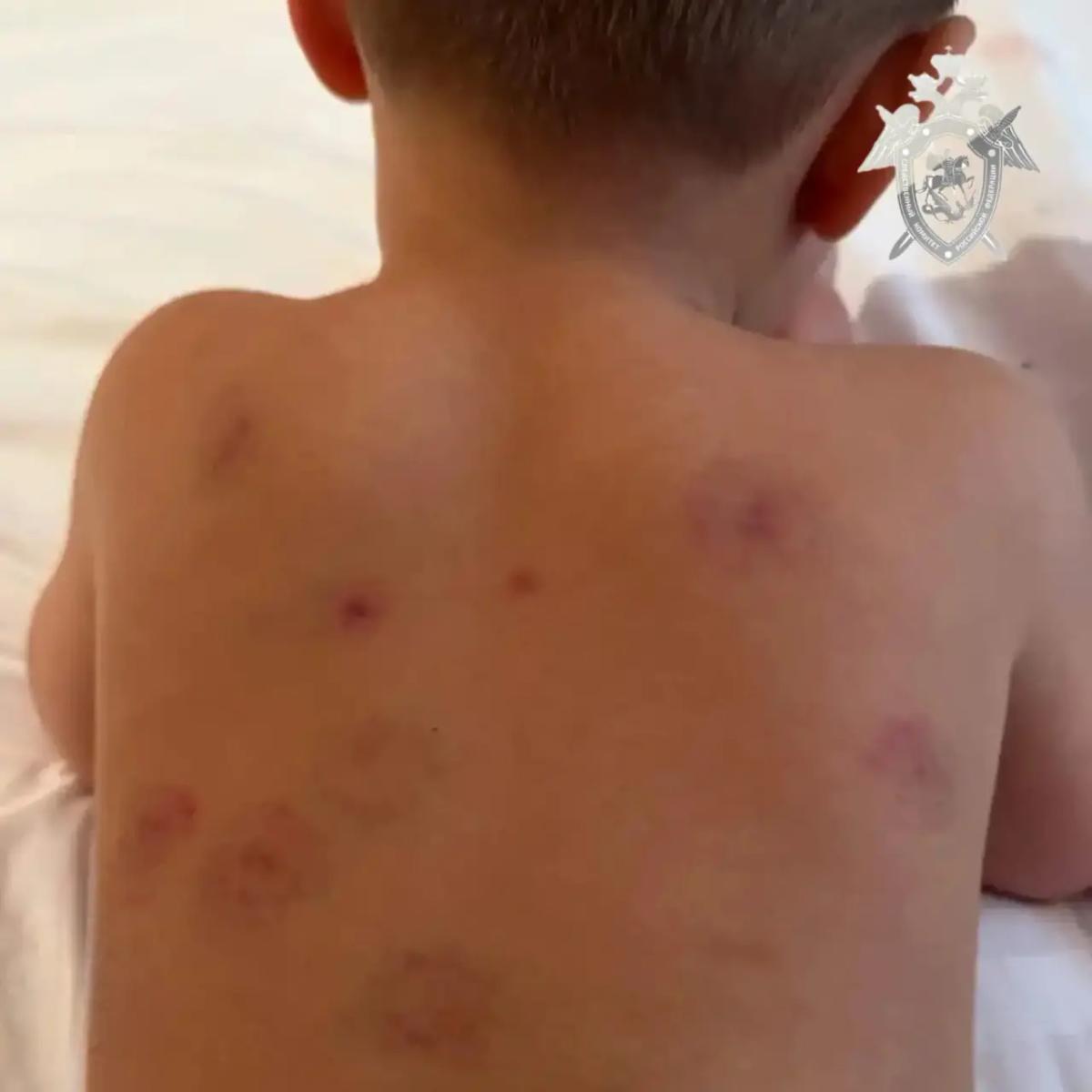 В Минеральных водах выясняют причину появления ран у воспитанника детсада
