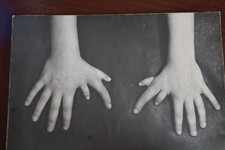 Врожденный порок - семь пальцев на руке.